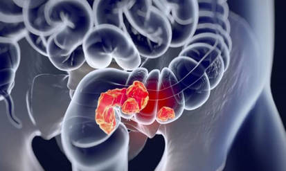 Колоректальний рак у разі раннього виявлення добре піддається лікуванню / Новости Винницы и области / Інформаційний портал На Парижі Новини Вінниці / Колоректальний рак у разі раннього виявлення добре піддається лікуванню